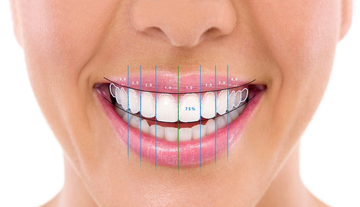 Das ideale Lächeln - digitale Zahnästhetik - denecke zahnmedizin